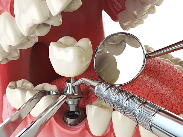 Best Emergency Dental Care for Sports Injuries in Oak Grove, SC